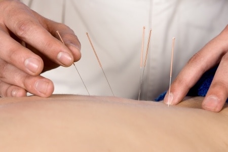 How Does Trigger Point Dry Needling Work?