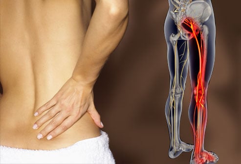 Sciaticatreatment zps7f2c6a3b - How Do I Treat My Sciatica Pain?