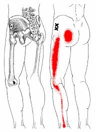 trigger point - How Do I Treat My Sciatica Pain (Part 6 of 6)